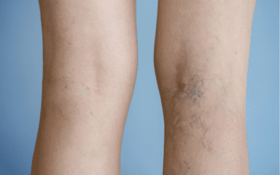 What Happens When Veins Are Damaged?